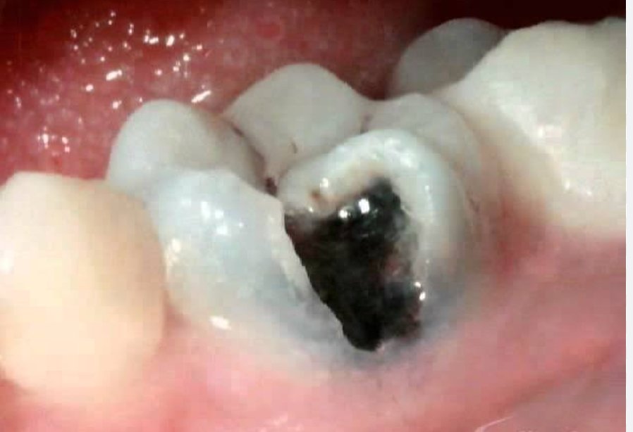 Cavity in Teeth Stages